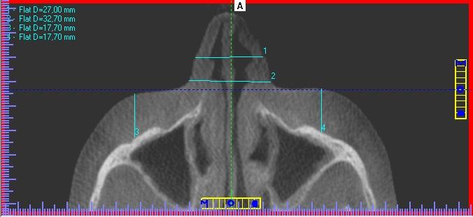 4 - Medidas de espessura dos malares e largura da base e das asas do nariz no corte tomográfico axial com os tecidos moles em sorriso amplo Espessura malar esquerda (Ponto malar ponto