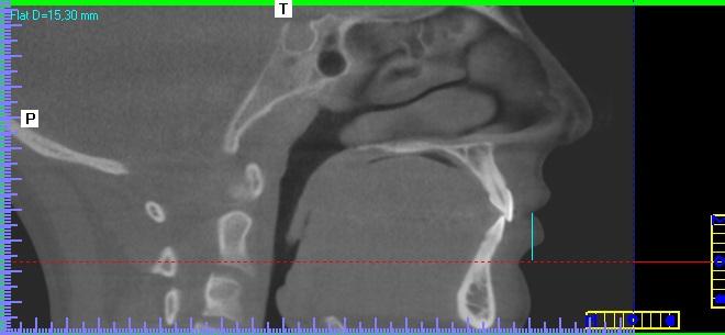 66 Figura 4.9 - Altura do lábio inferior no corte tomográfico sagital com os tecidos moles em repouso Figura 4.