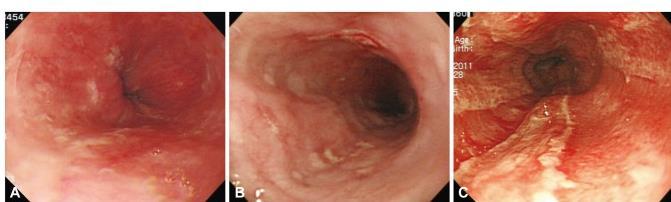 Abordagem Endoscopia digestiva alta - Precoce (3-48 horas): avalia extensão e gravidade das lesões luminais; - Prediz