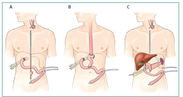 Abordagem cirúrgica - Esofagogastrectomia (abordagem combinada cervical e abdominal) mais comum;. Morbi-mortalidade elevadas.