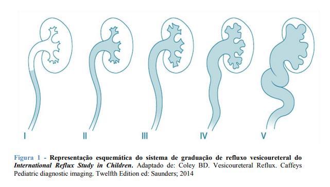 O sistema de classificação é baseado na aparência da UCM, sendo o grau I o mais leve e o grau V o mais grave. No caso de atingimento bilateral o RVU é graduado de acordo com o lado mais grave.