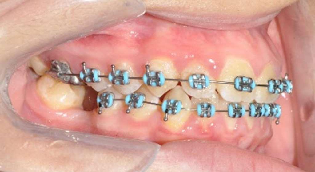 O aparelho dentosuportado do tipo Hyrax, se mostra