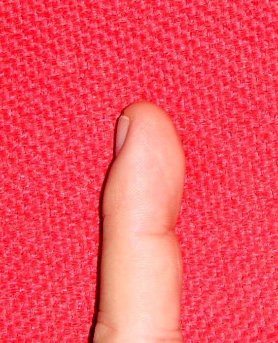 Lesão de polpa digital Considerações anatômicas Presença da unha e leito ungueal