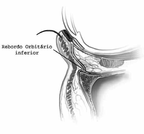 Figura 1 Transecção sagital da órbita demonstrando o acesso transconjuntival e dissecção pré-septal até o rebordo orbitário inferior.