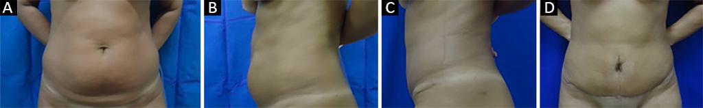 A sutura é realizada em três planos, subcutâneo, subdérmico e intradérmico (Figura 17). Figura 17. Aspecto final após sutura em 3 planos (sucbcutâneo, subdérmico e intradérmico).