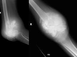 Analise radiográfica de uma lesão