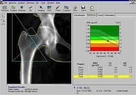 Densitometria óssea A forma primária da osteoporose