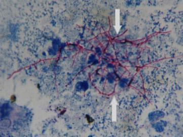 detecção -10 4 bacilo/ml material Mycobacterium, Nocardia