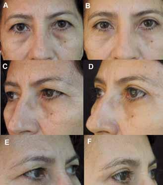 A, C e E: Pré-operatório.  Figura 6 Paciente de 46 anos com dermatocalase e bolsas gordurosas.