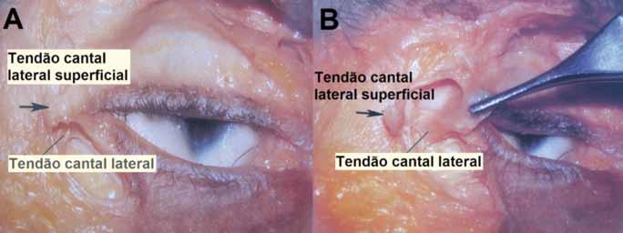 Macedo Franco JE T et et al. Figura 8 A: Dissecção do tendão cantal lateral superficial. B: Tendão cantal lateral e tendão cantal lateral superficial de Knize (seta e pinça).