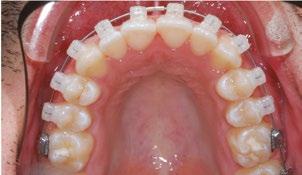 consulta de ortodontia na White Clinic devido a insatisfação estética.