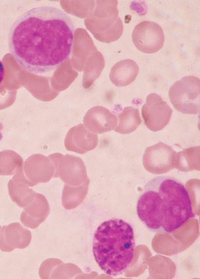 7 anemia ou discreta anemia normocítica e normocrômica.