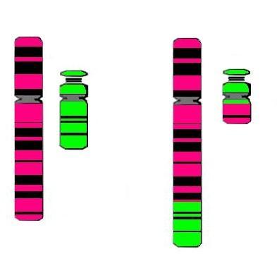 Figura 8 - Cariótipo de paciente com Leucemia Mielóide crônica, evidenciando a translocação entre os cromossomos 9 e 22 15. 3.4.