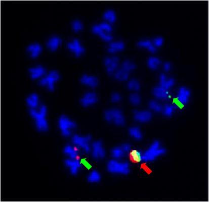 12 Figura 10 - FISH evidenciando o gene BCR e o gene ABL não rearranjados como sondas nas cores verde e vermelha, respectivamente (setas verdes).