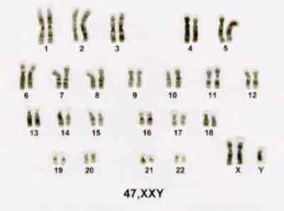Cariótipo Alterações nos pares de cromossomos