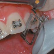 movimiento de dientes que se asocia con al ambres activos.