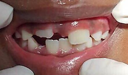 mostrando que tendência é que este dente
