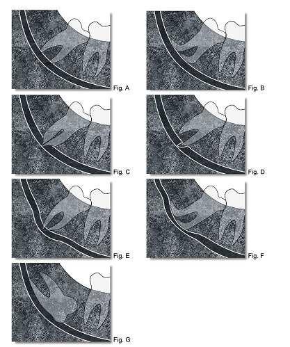 Fig. 2: A - Escurecimento da raiz; B - Deflexão de raiz; C - Estreitamento de raiz; D - ápice bífido; E - Desvio de canal; F - Estreitamento do canal; G - Interrupção na linha branca do canal.