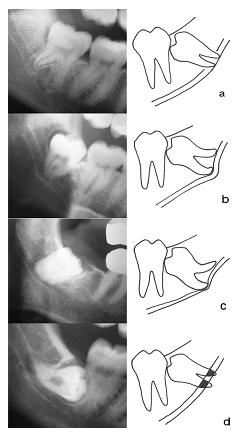 Fig. 3: Sinais radiográficos em panorâmicas: A interrupção da linha branca; B - Deflexão do canal; C - Estreitamento do canal; D escurecimento da raiz. (SZALMA, J. et al.