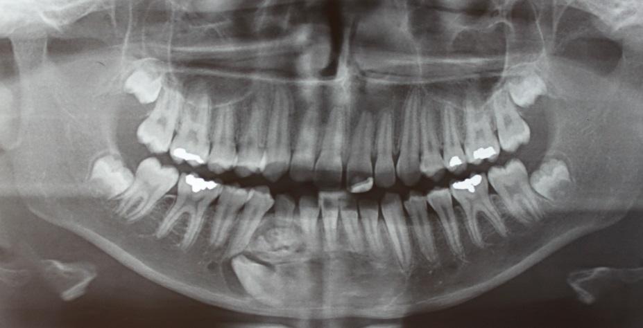 10 2 RELATO DE CASO Paciente de 13 anos de idade, sexo masculino, foi submetido a exame odontológico de rotina, onde foi observada a retenção prolongada do canino decíduo inferior direito e ausência