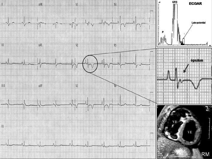 Displasia arritmogênica do ventrículo direito: relato de caso e revisão dos critérios diagnósticos e atuais das indicações de cardiodesfibrilador implantável (CDI) Relato do caso Paciente com 20 anos
