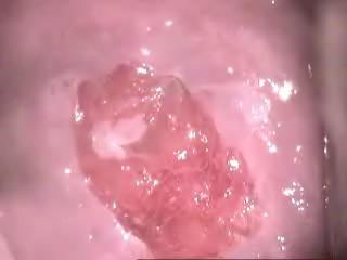 INCA/MS - Câncer de colo uterino - 2007 Exérese da zona de transformação do colo uterino Consiste na retirada da