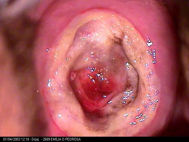 zone) consiste em retirada de tecido cervical usando alça