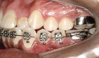Os ganhos transversais são atribuídos igualmente às inclinações dentárias e à rotação dos segmentos maxilares, fatores estes que