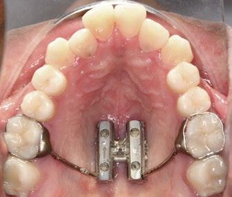 Há um consenso a respeito das desvantagens da ERM relativas aos efeitos negativos nas estruturas dentárias e de suporte, como: reabsorção