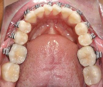 Outra desvantagem se refere à inviabilidade da técnica que ocorre quando não há pilares dentários suficientes para ancoragem ou quando