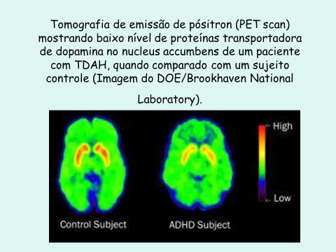 Bases neurobiológicas: -baixa atividade cerebral frontal e menor volume pré-frontal