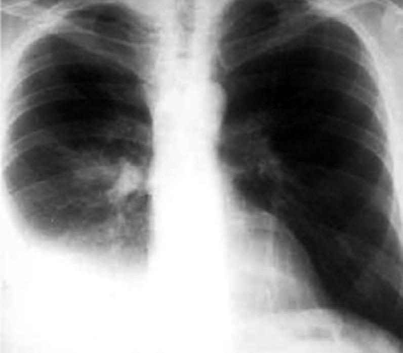5 Líquido pleural 1. Introdução O espaço pleural é a região entre a caixa torácica e a camada serosa que envolve o pulmão, chamada pleura.