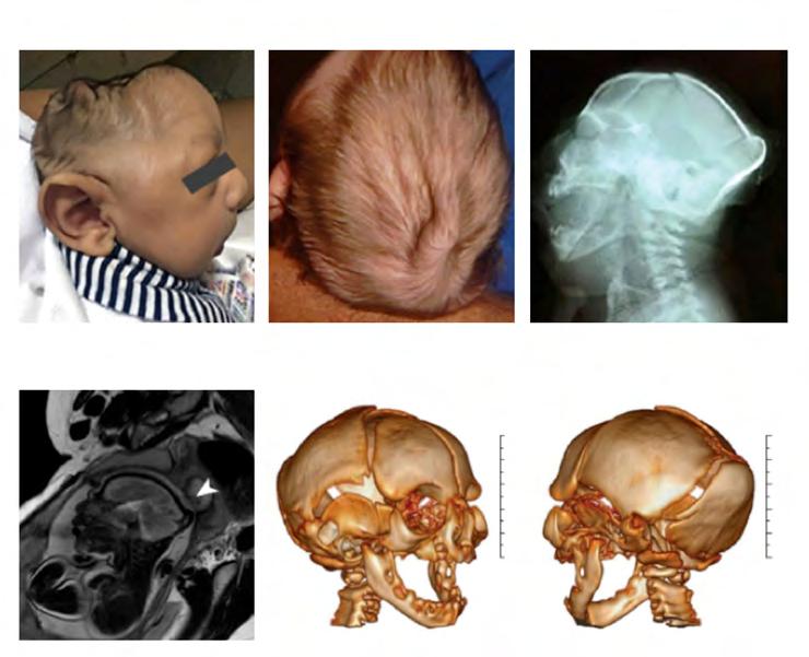 Figura 1 Características do crânio de crianças com síndrome congênita associada à infecção pelo vírus Zika, segundo publicação da revista científica JAMA (Journal of the American Medical Association)