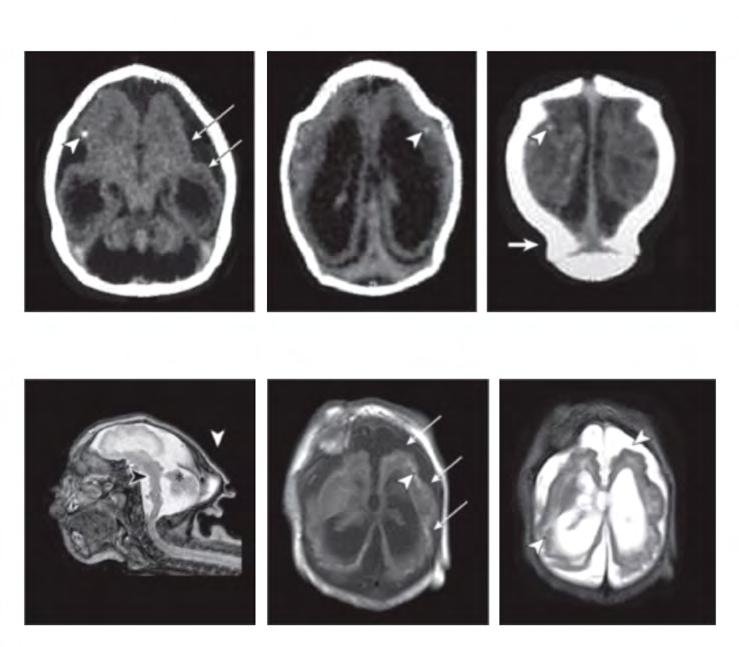 Na Figura 2 a tomografia computadorizada de um RN e a ressonância magnética de outra criança com exposição pré-natal ao vírus Zika mostram calcificações pontuais dispersas (observe a ponta das