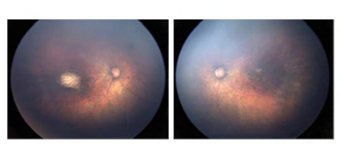Na Figura 3 são apresentadas imagens de Fundo de olho com grande angular (RetCam) de um menino com infecção congênita pelo vírus Zika.