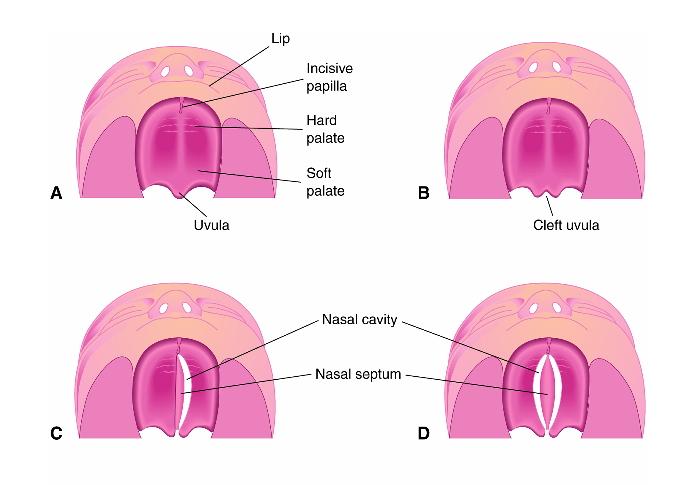 Fendas palatinas Lábio e palato normais Lábio Papila incisiva Palato duro Fenda palatina que atingiu apenas a úvula