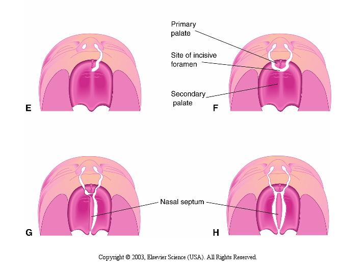 Fendas labiais e palatinas Fenda labial e do processo alveolar da maxila, unilateral do palato primário Palato primário Local do forame incisivo Palato secundário Fenda bilateral completa do lábio e