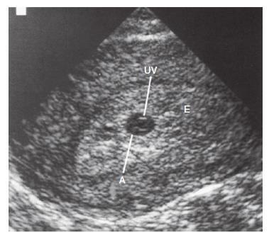 Introdução Ultrassonografia (3 semanas): Fonte: Moore K,