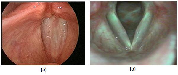 Comunica-se inferiormente com a traqueia e superiormente com a faringe [28]. As funções básicas da laringe, em ordem de importância são proteção ds vias aéreas inferiores, respiração e fonação.