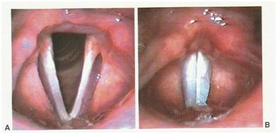 Figura 2.4 Imagens da laringe adulta, obtidas por telelaringoscopia. A. Durante a respiração. B. Durante a fonação. Fonte: [26].