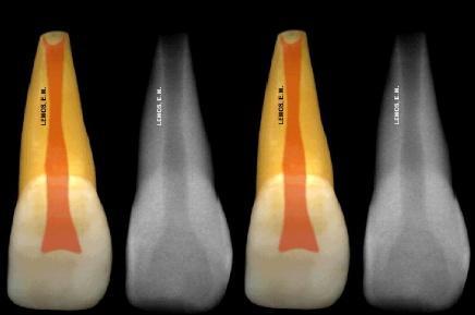 6 Conforme Toledo et al (2010), é classificado o elemento dentário com rizogênese incompleta, quando este processo não ocorre completamente (Fig.