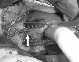 A artéria torácica interna esquerda é dissecada da parede do tórax com uso parcimonioso de eletrocautério, até próximo da sua origem na artéria subclávia esquerda, com a técnica de esqueletonização.