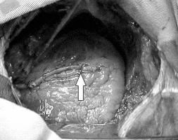 A seguir, o pericárdio é parcialmente aberto no sentido longitudinal e o coração deslocado medialmente com a colocação de pequenas compressas sob a parede lateral do VE, expondo a ADA.