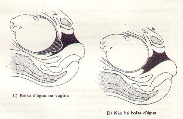 rotura espontânea - acontece