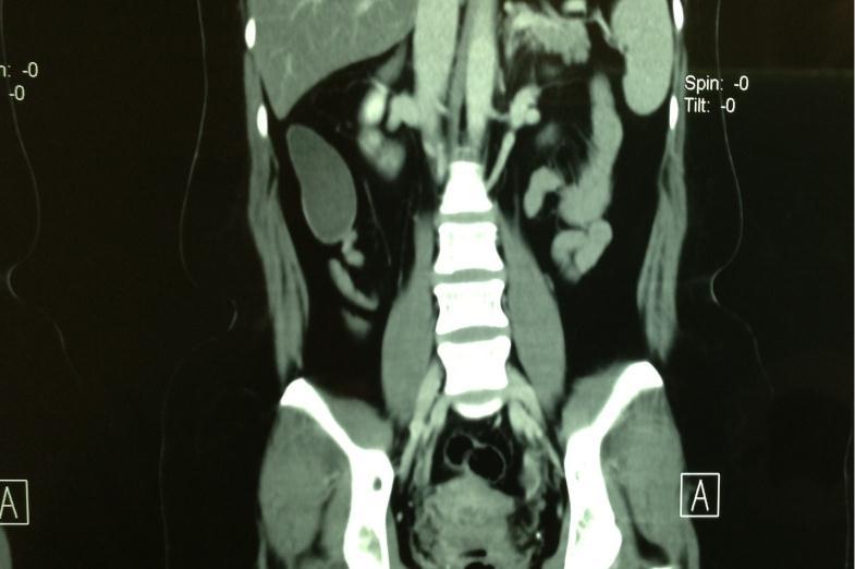 A tomografia computadorizada (TC) é o padrão ouro para esse diagnóstico, mostrando: neoplasia cística tubular junto ao ceco, de paredes regulares e lisas, com ou sem septação e atenuação