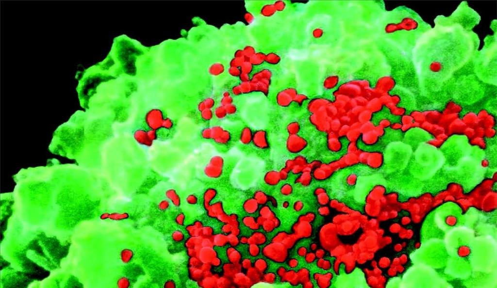 Linfócito T, em verde, infectado por vírus HIV, em vermelho