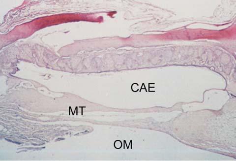 Otomicroscopia mostrando intensa opacificação difusa da membrana