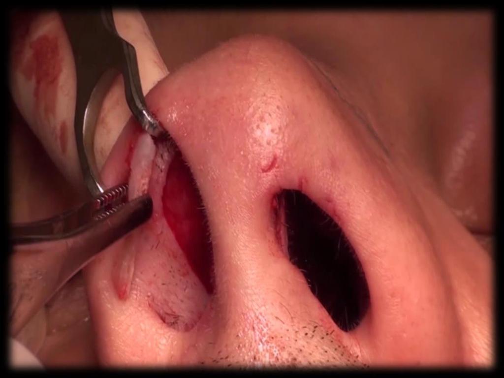 Comentários Os métodos para correção do colapso da válvula nasal consistem no reposicionamento das cartilagens nasais ou no uso enxertos para dar suporte à pare nasal lateral.