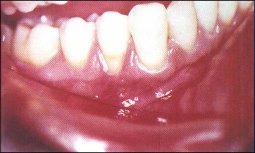 Figura 1 Foi então, o paciente reeducado sobre a higiene oral correta sem traumatismos e realizado um exaustivo ajuste oclusal, estabilizando a oclusão.