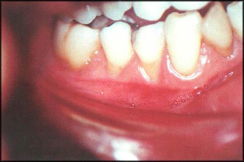 Figura 4 No exame clínico foram constatados duas recessões de 5,0mm no 1º e 2º pré-molares inferiores esquerdos.